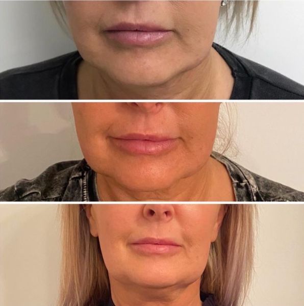 hyaluron pen filler before and after