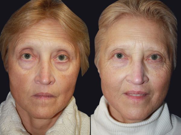injecting fat cells into face
