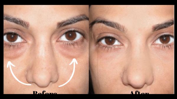 gac injections before and after