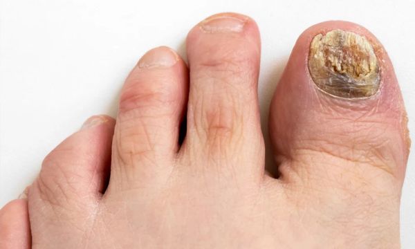 ingrown toenail anatomy