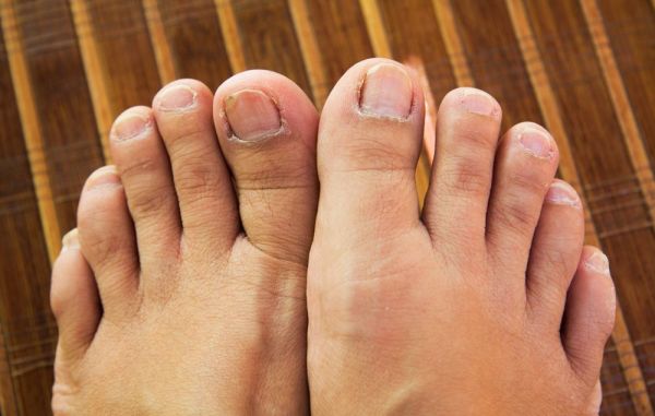toenails turning yellow