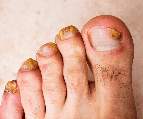 folliculitis