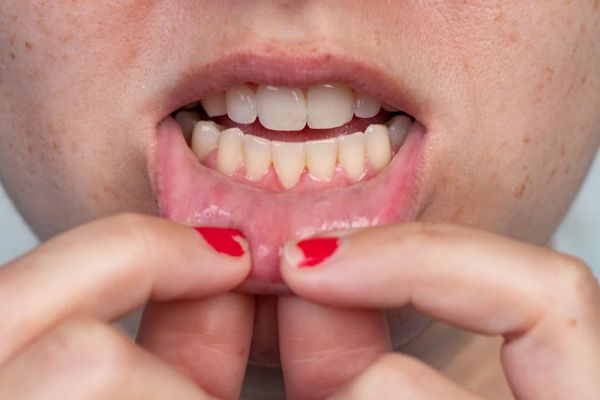 frenulum laceration