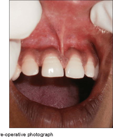 bump on lingual frenulum