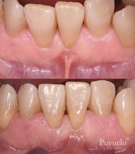 frenectomy