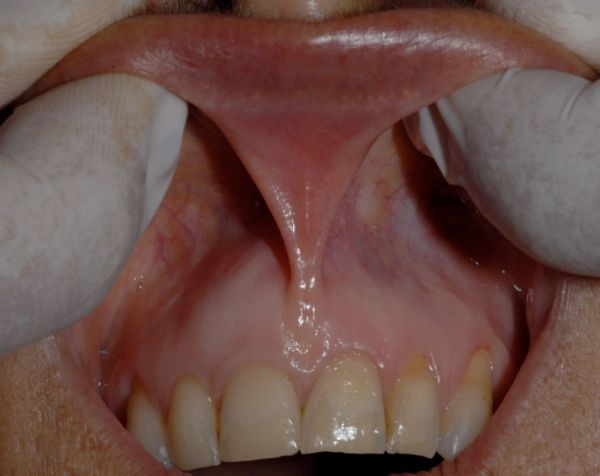 lingual frenulum absent