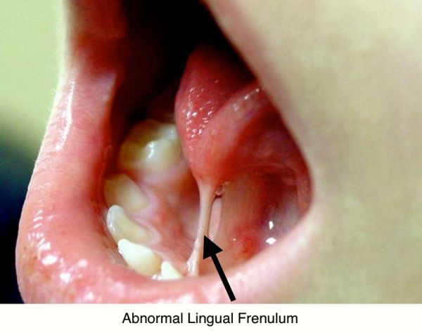 white lump frenulum
