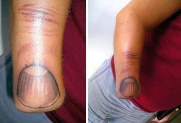 congenital amputee man