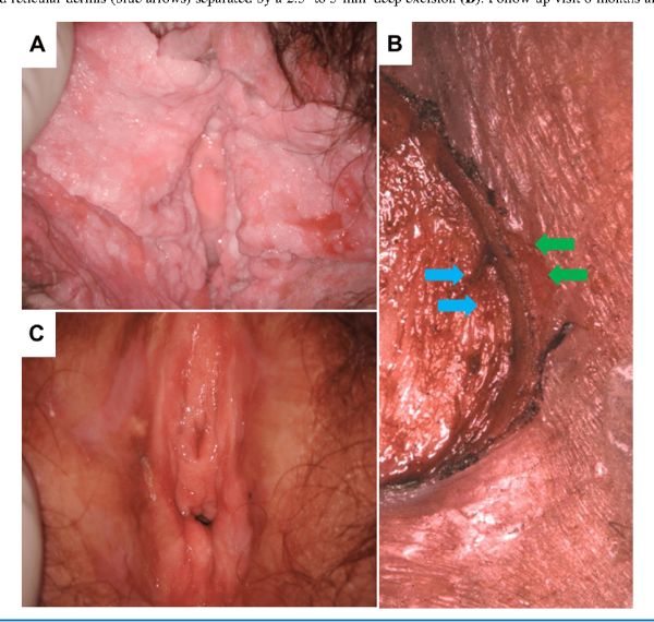 severe lichen sclerosus