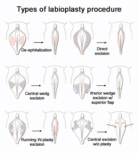 labial puff injections