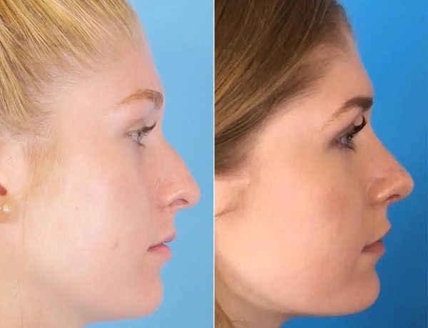german beak nose