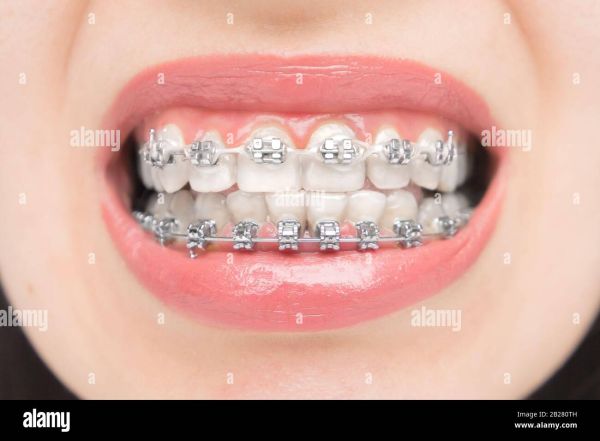 broken braces wire