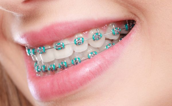 braces colors for girls teeth