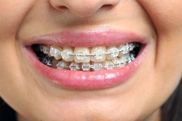 lavender braces color