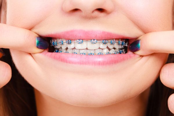 girl dental braces