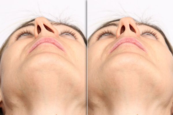 nasal septum perforation symptoms