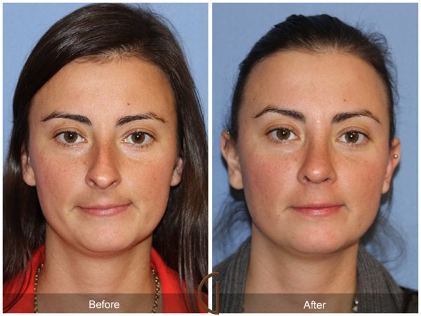 scars after plastic surgery