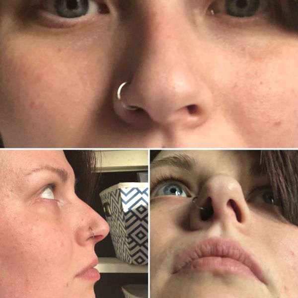 nasal fracture