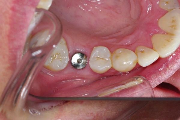 front tooth implant before and after