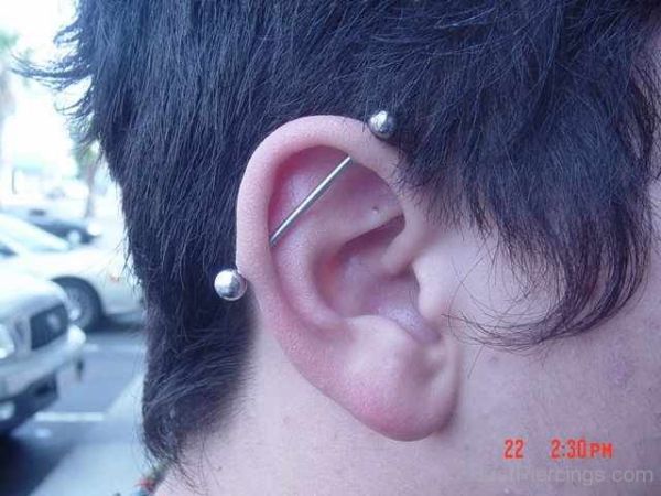 keloid ear