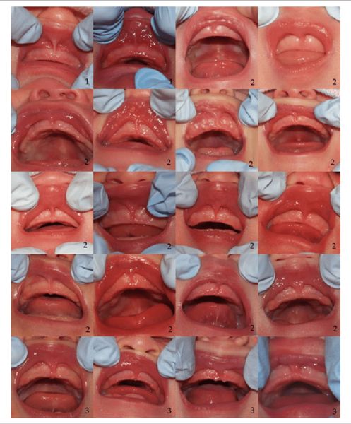 diastema frenum
