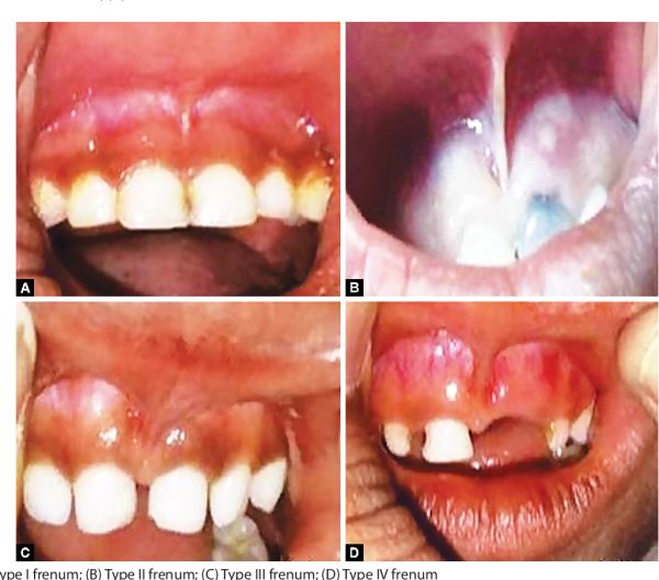 canker sore