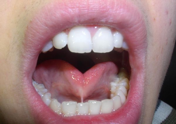sublingual