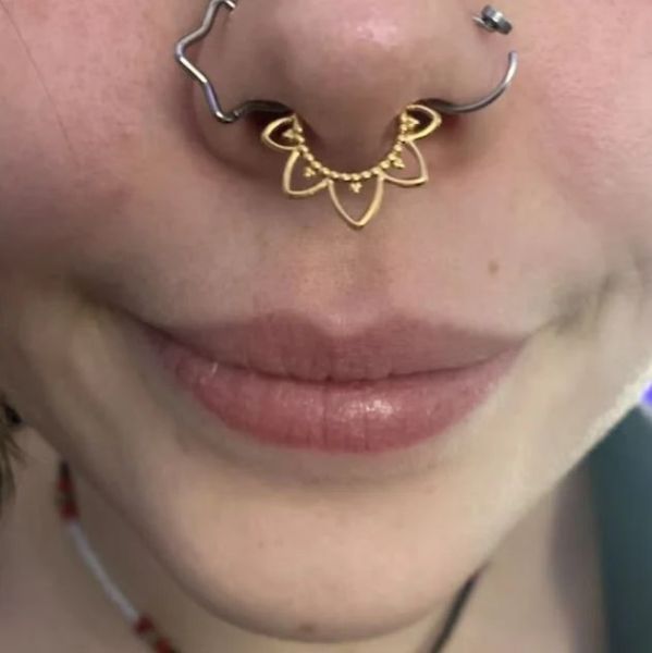 nasal septum perforation