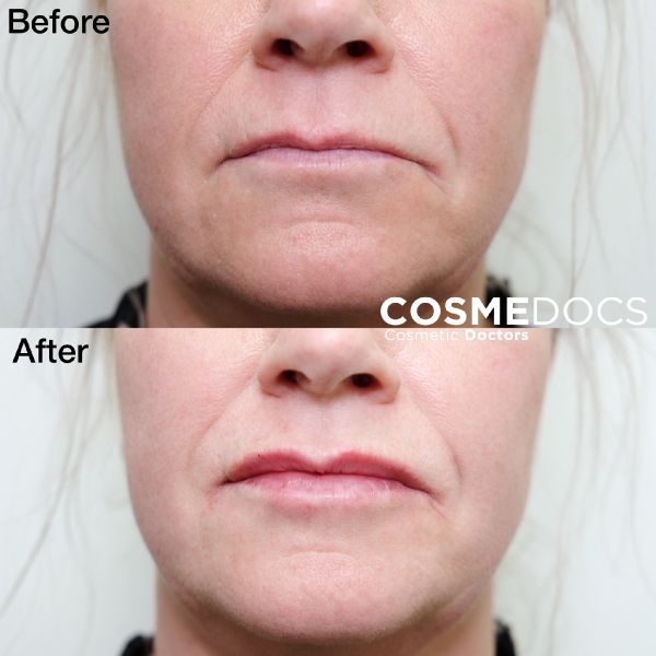 dark upper lip