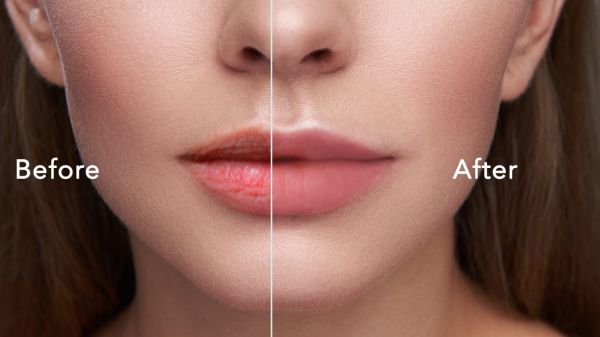 full lip injections