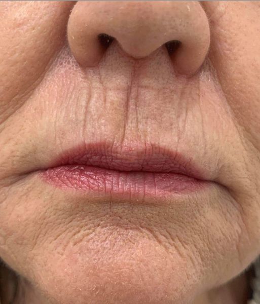 age spots