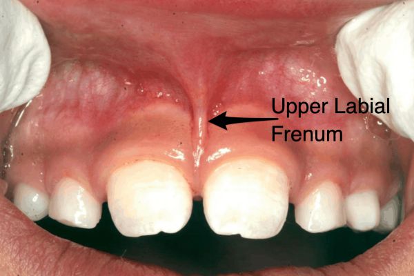 anterior tipped