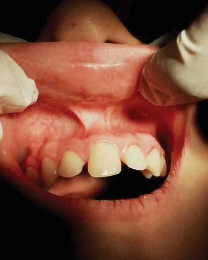 solitary maxillary central incisor