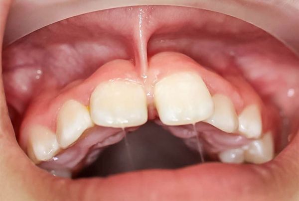 labial frenulum red