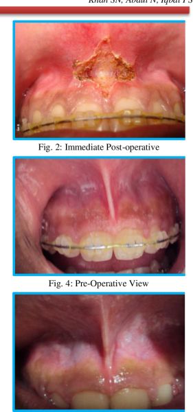 labial release