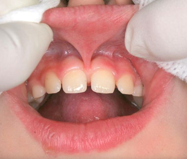 above lip anatomy