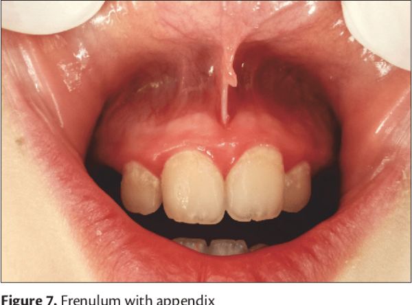 removed fenulum