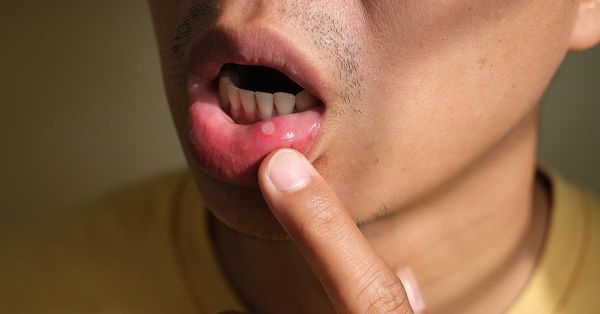 gum irritation