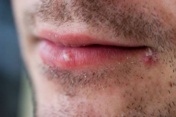 skin cancer warts