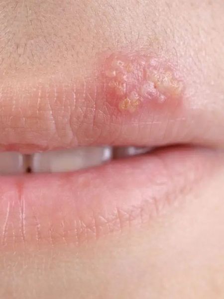 upper lip
