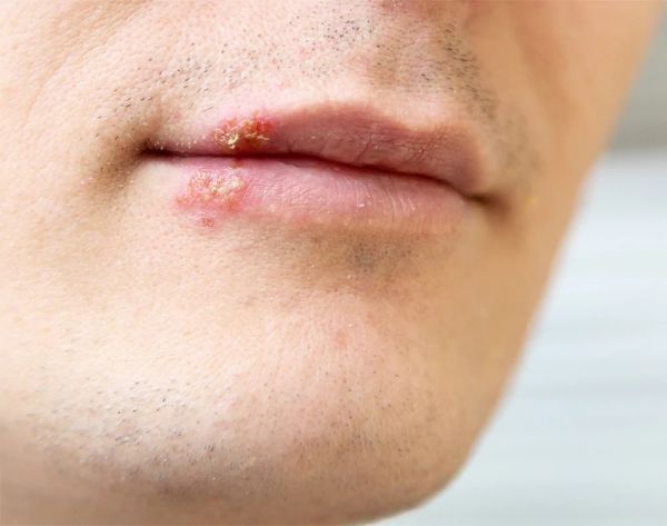open sores on arms and legs