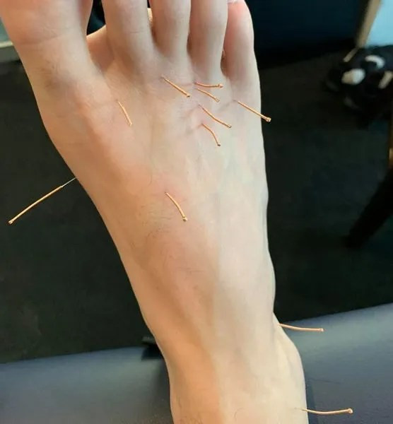 broken foot pins