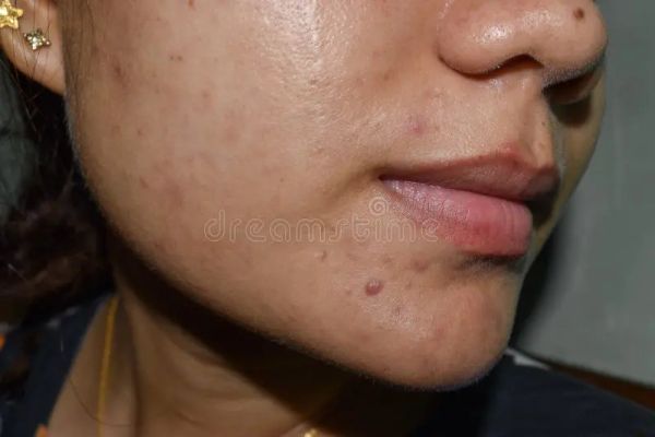 skin peeling oil