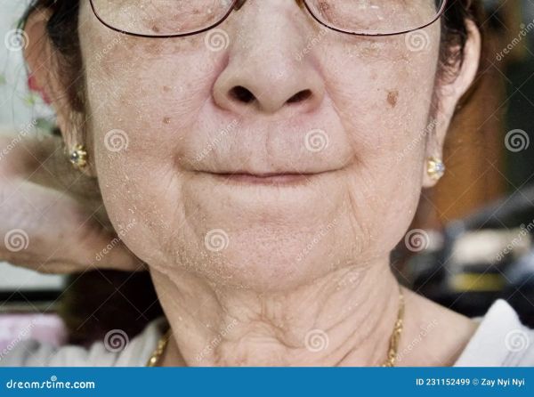 tech neck wrinkles