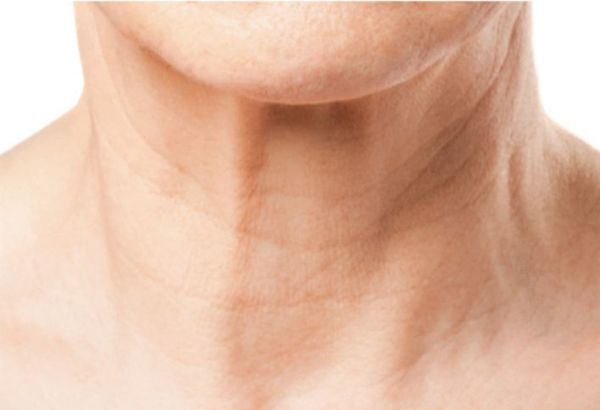 what are all the lines standing out on a neck