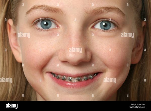 root canal