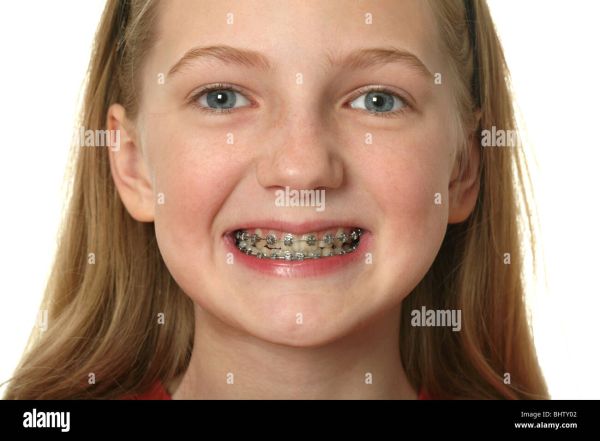 girl with crooked teeth