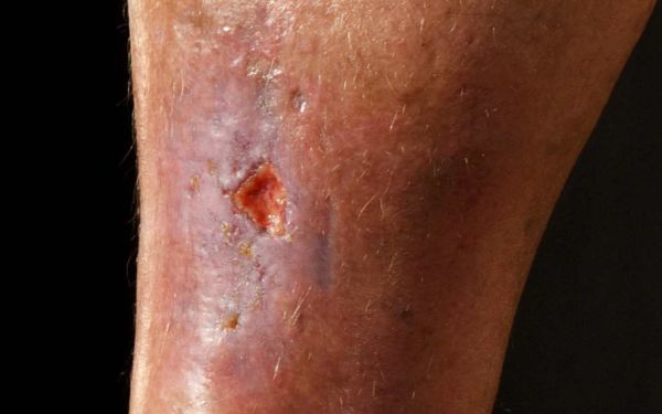pressure ulcer wound stages