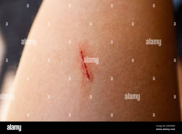 thifh part wound