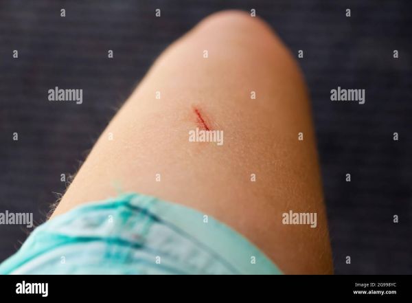 2 cm open wound